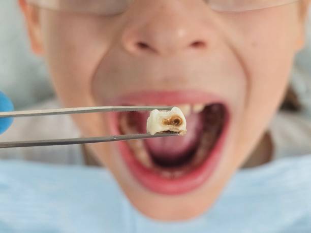 Best Emergency Root Canal Therapy in Kent City, MI